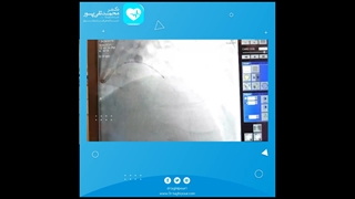 آنژیوپلاستی و آنژیوگرافی در بیماری با آنژین قلبی