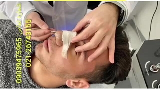 جراحی زیبایی بینی با استفاده از پیوند غضروف گوش