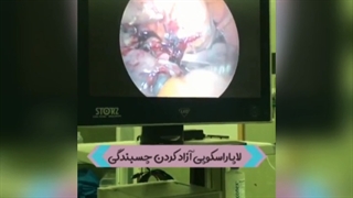 عمل لاپاراسکوپی آزادکردن چسبندگی های رحمی