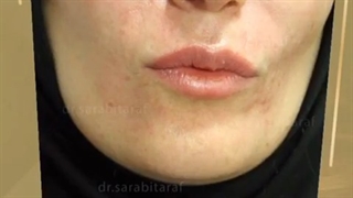 قبل و بعد از رفع غبغب (دکتر سارا بی طرف)