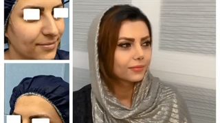 جراحی بینی