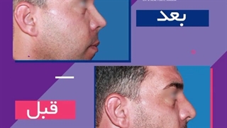 عمل همزمان بینی گوشتی و لیفت پیشانی به روش بای کرونال