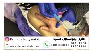 فیلم واقعی لاغر کردن دست با مزوتراپی