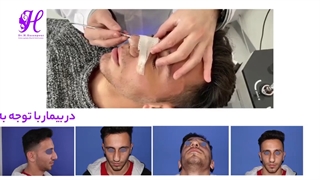 جراحی بینی با گرفتگی و کجی شدید بینی