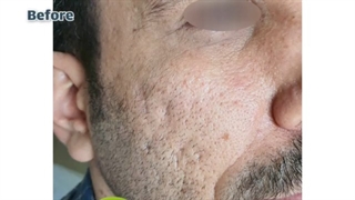 نتیجه پس از یک جلسه سابسیژن و رفع خطوط پیشانی اتوپلاستی