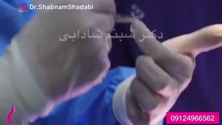 لیفت اندوسکوپیک ابرو و گونه با اندوتاین