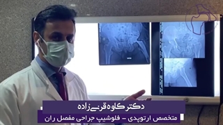 جوش نخوردگی شکستگی استابولوم