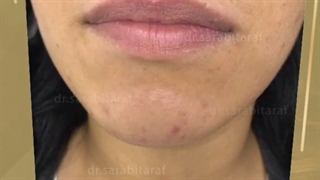 تزریق ژل لب روسی