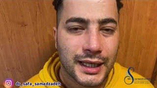 نمونه ای جراحی بینی مردانه
