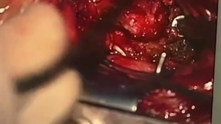 عمل جراحی دکامپرسیون و فیکساسیون