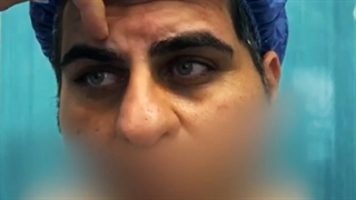 جراحی بینی گوشتی و لیفت با اندوسکوپ و اندوتاین