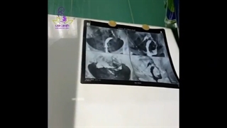 عکس رنگی و هیستروسکوپی و لاپاراسکوپی در خانمی با رحم تک شاخ و ناباروری