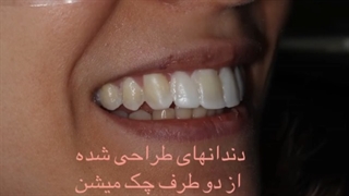 ویدیوهای معرفی سیستم لامینیت Unique Smile | دکتر لیلا عطایی