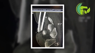 فیلم واقعی و بدون سانسور خرد شدن استخوان ران و نتیجه بعد عمل