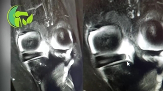 فیلم درمان پارگی ریشه مینیسک