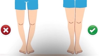 درمان پاهای پرانتزی