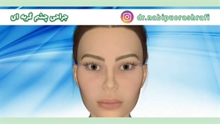 نحوه انجام عمل چشم گربه ای