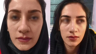 فیلم واقعی کوچک کردن بینی با پلاسما جت