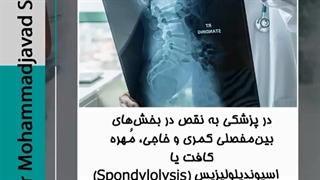 لغزش مهره ها بر روی همدیگر چیست؟