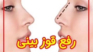 از بین بردن قوز بینی با تزریق ژل