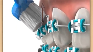 نکاتی که در مسواک زدن حین درمان ارتودنسی باید رعایت کرد | دکتر فرهاد گرجی