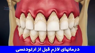 درمانهای لازم قبل از ارتودنسی | دکتر احسان مهریزی