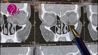 خروج کیست چرکی داخل چشم از راه بینی