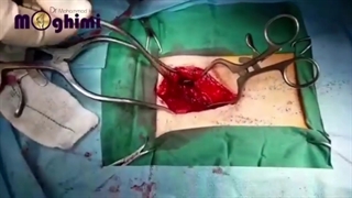 عمل بدون سانسور جراحی باز دیسک کمر و عمل همی لامینکتومی