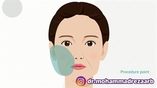 لیفت صورت با نخ