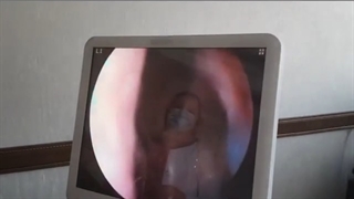 کنترل سینوس با دستگاه آندوسکوپ