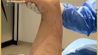 فیلم واقعی جراحی لیپوماتیک بازو