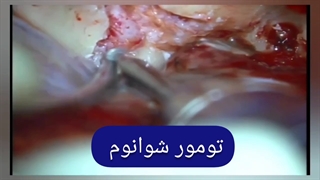 تومور شوانوم