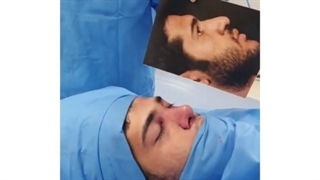 فیلم جراحی واقعی بینی مردانه