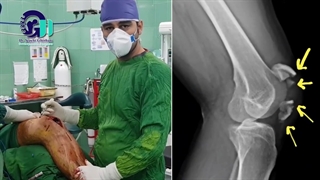 عمل جراحی شکستگی استخوان کشکک زانو