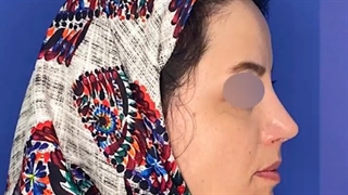 نتیجه جراحی زیبایی بینی بعداز سه ماه
