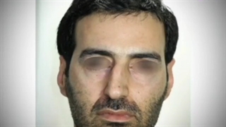 جراحی بینی و تزریق چربی صورت توسط دکتر فرزادفرد برداشتن توده