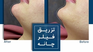 تزریق فیلر چانه