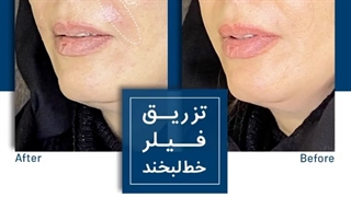 فیلر خط لبخند