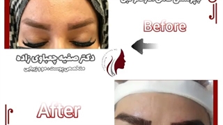 فیلم کاشت ابرو طبیعی، قبل و بعد