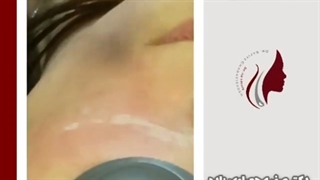 فیلم رفع دائمی اسکار زخم قدیمی با لیزر اربیوم