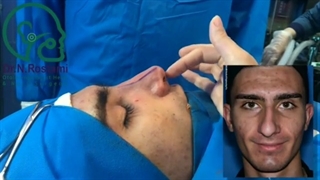 نمونه جراحی بینی مردانه از دکتر نصیبه رستمی
