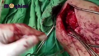 فیلم واقعی و بدون سانسور عمل جراحی روتاتورکاف شانه
