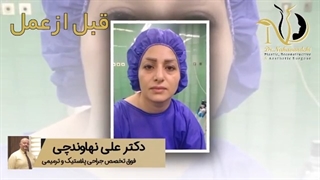 فیلم واقعی جراحی بینی، از قبل تا بعد عمل