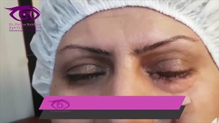 اصلاح رتراکسیون پلک تحتانی توسط بهترین جراح چشم