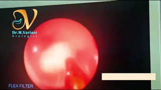 درمان سنگ کلیه