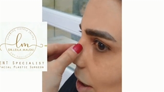 فیلم ده روز بعد از جراحی زیبایی بینی