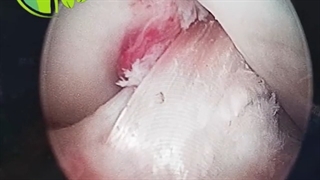 فیلم بدون سانسور ترمیم درست و خوب بازسازی رباط صلیبی