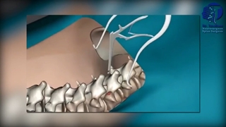 جراحی انحراف ستون فقرات