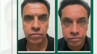 بخشی از نمونه جراحی های لیفت ابرو و پیشانی