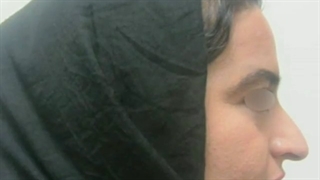 نمونه جراحی زیبایی بینی بلافاصله بعد از عمل توسط دکتر اصحاب یمین